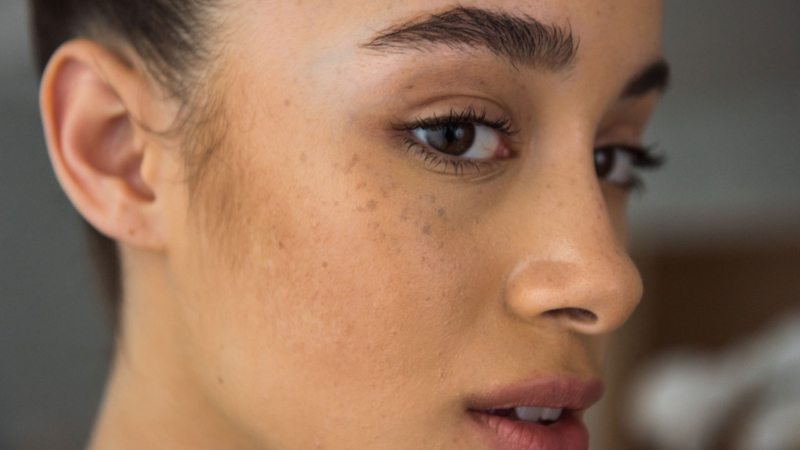 Hyperpigmentation in Darker Skin Tones: What Causes It and How Can I Treat It?