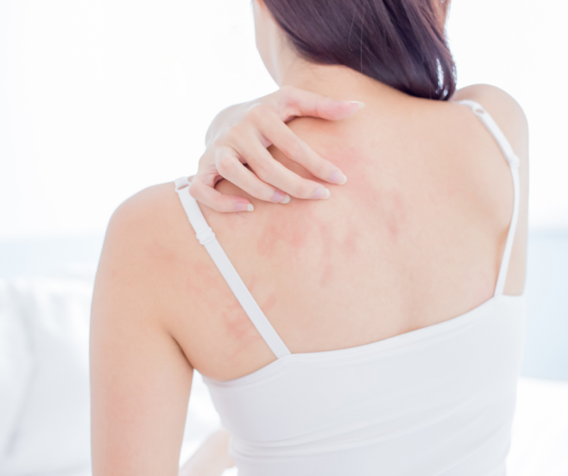 The Different Types of Eczema and How to Treat Them