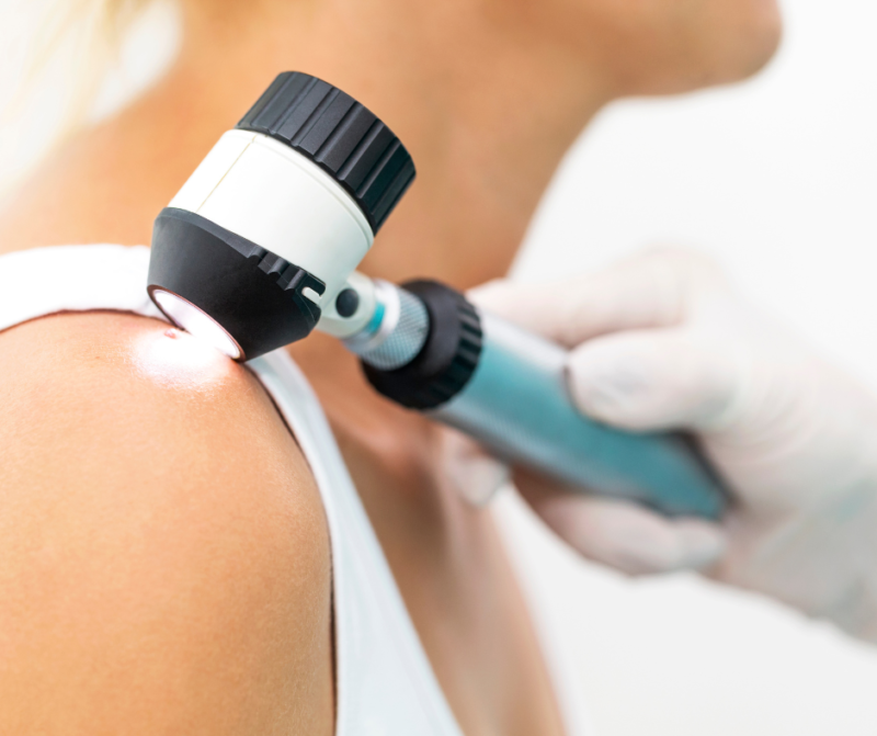 Skin Cancer: How to perform a skin self-exam